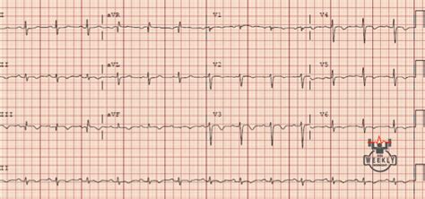 borderline ecg|borderline ecg rightward axis.